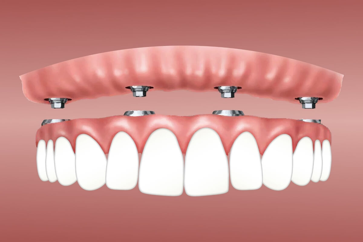 Implantes dentales de boca completa: opciones, precios y resultados