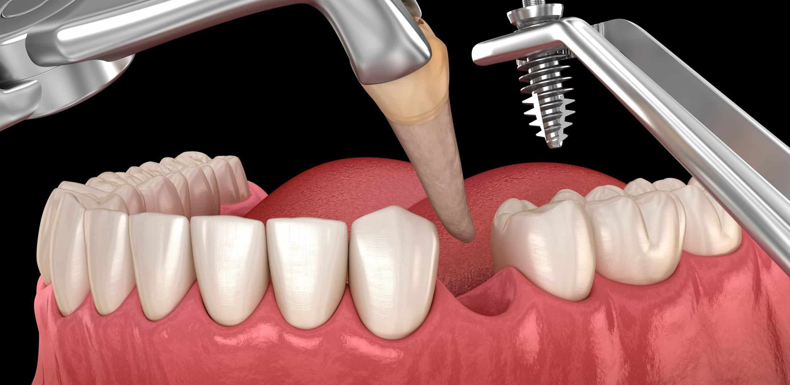 Implantes dentales de carga inmediata: qué son y quiénes pueden usarlos