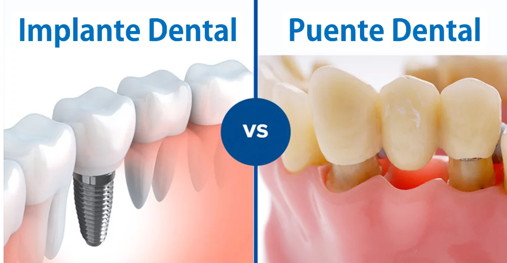 ¿Cuándo conviene un puente dental en lugar de un implante? Guía práctica