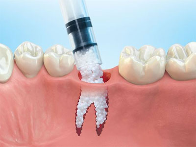 Implantes dentales y salud ósea: importancia del injerto de hueso
